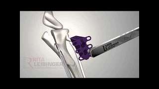 10,000 Happy Dogs: The 3D Printed TTA RAPID™ Implant screenshot 4