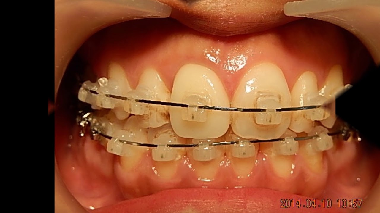 Orthodontic libraryPH. Open bite,etc Chart No.5430 YouTube