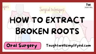 4 ways to extract broken root tips and when to LEAVE THEM ALONE @mentaldental @DentalDigest screenshot 2