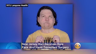 'Got A New Chance At Life': Joe DiMeo Relearning How To Smile, Squeeze Following Rare Face & Hands T
