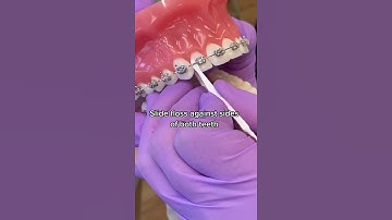 How to remove the gunk out of your braces!  Using the platypus floss and proxabrush.