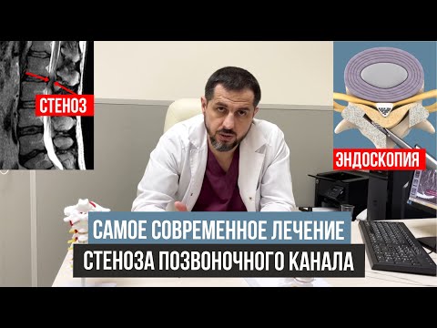 Видео: 4 способа лечения стеноза позвоночника