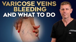 Can Varicose Veins Bleed Yes—and Here’s What to Do