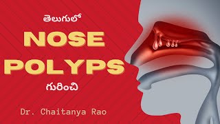 నాసల్ పాలిప్స్ కి అంతిమ పరిష్కారం | Nasal polyps breakthrough Rx by Sinus Doctor 11,170 views 11 months ago 16 minutes