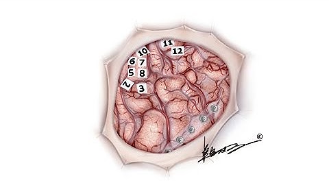 Functional maps of direct electrical stimulation-induced speech arrest and anomia