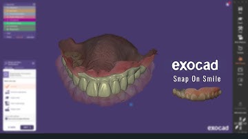 Exocad Snap on Smile Tutorial