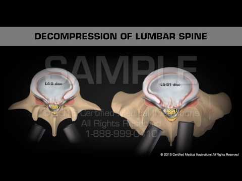 Декомпрессия поясничного отдела позвоночника