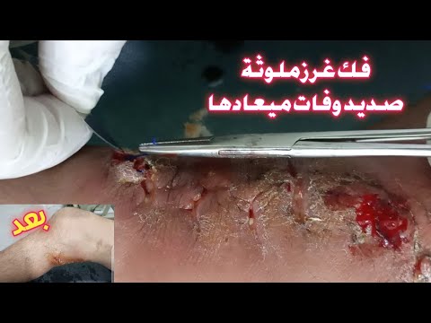 فك غرز جرح ملوث وأسباب الصديد والتلوث المبلغاتي ا ال مبلغ المبلغ مبلغات
