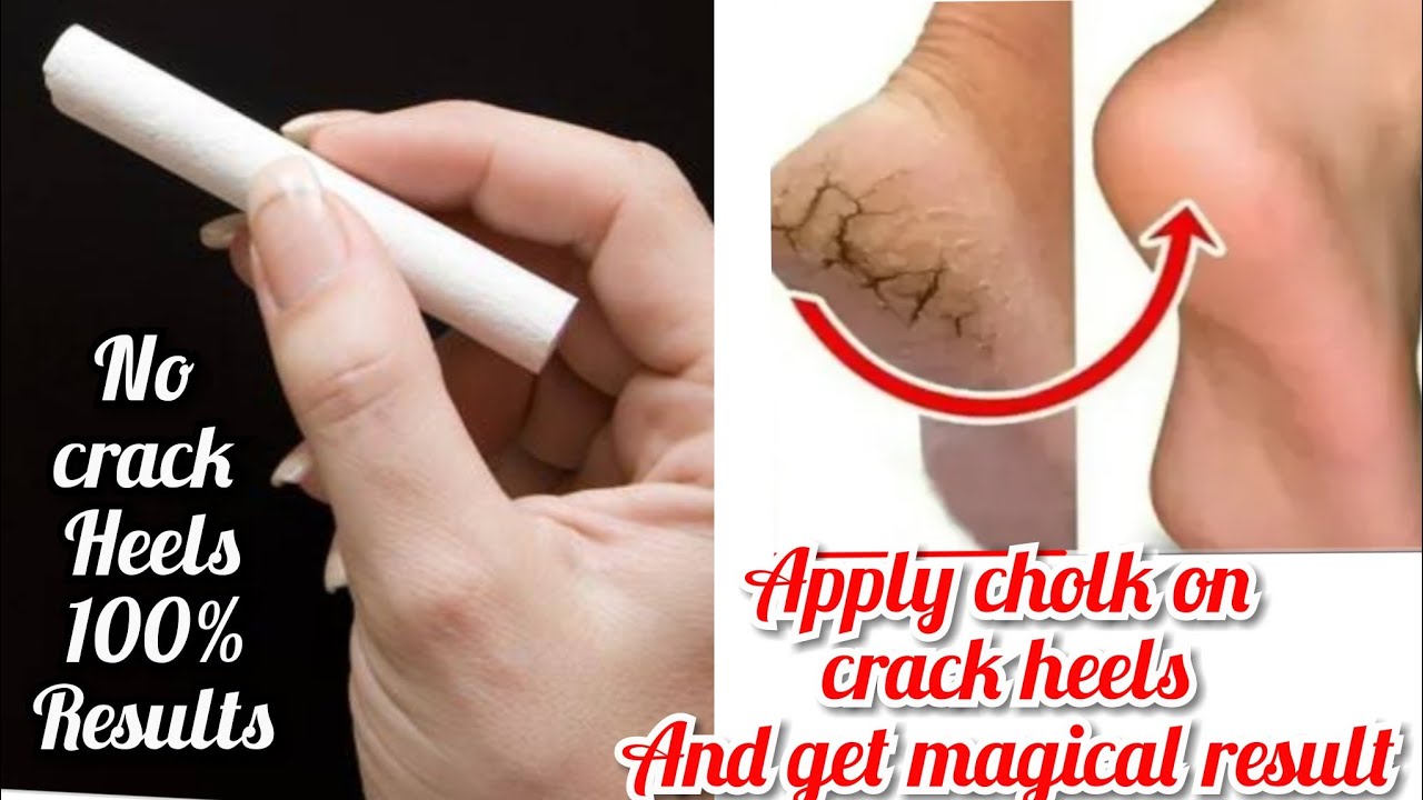 The final solution of crack on your feet crack heel treatment crack