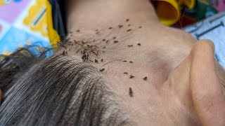 Remove thousand lice from her hair - Getting out all of her head