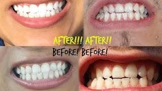 HOWTO: KEEP YOUR TEETH WHITE AT HOME USING SMILE BRILLIANT! REQUESTED