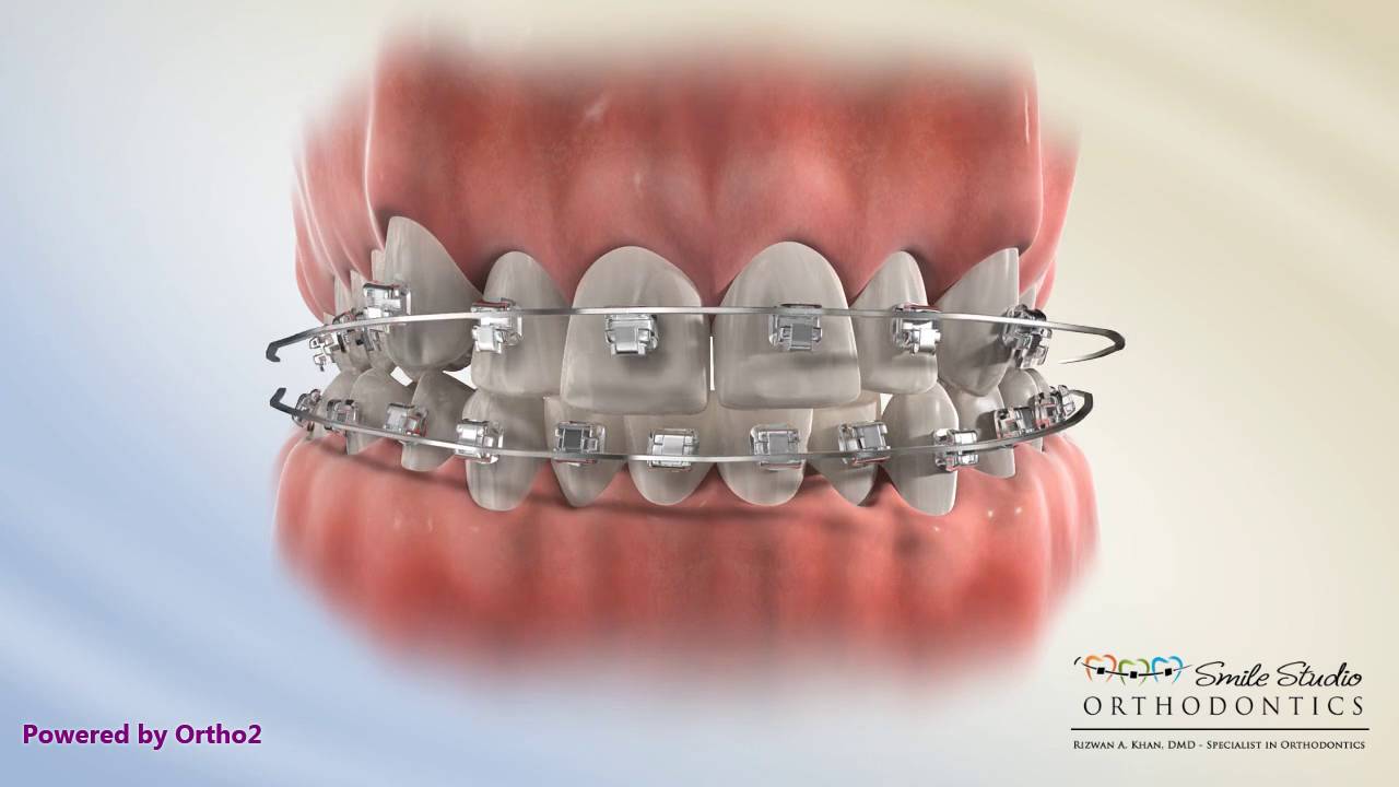 Damon Posterior Crossbite Orthodontic Treatment YouTube