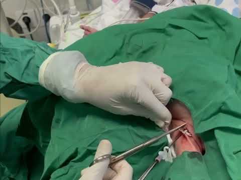 Video: Bagaimana cara melepas kateter sentral yang dimasukkan secara perifer?
