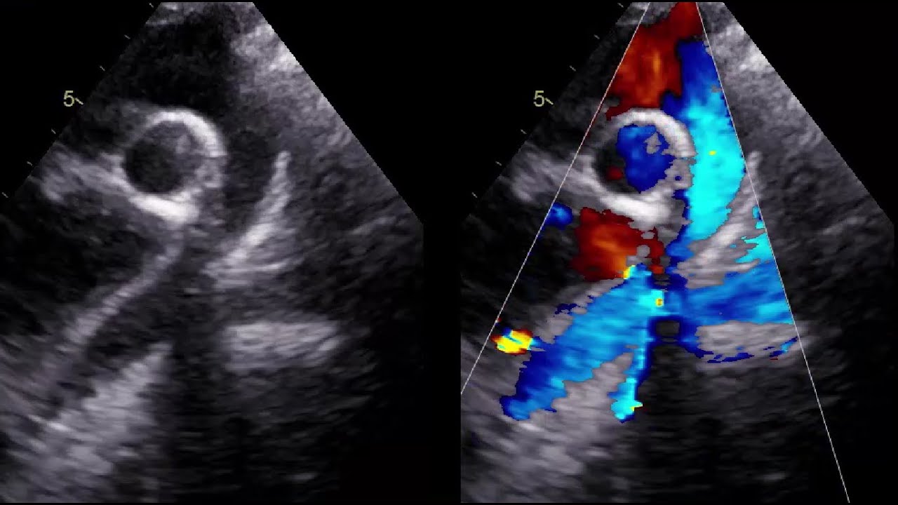 Aortic Arch "Ideal vs non ideal imaging" - Pediatric Echo Tips Series (1)