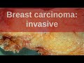 Breast Carcinoma: Invasive - Pathology mini tutorial