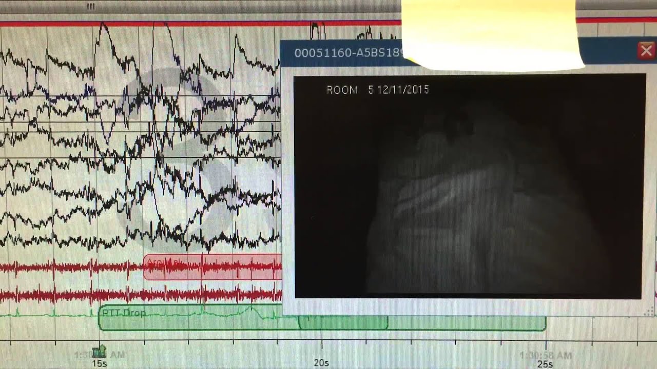 REM sleep behavior disorder YouTube