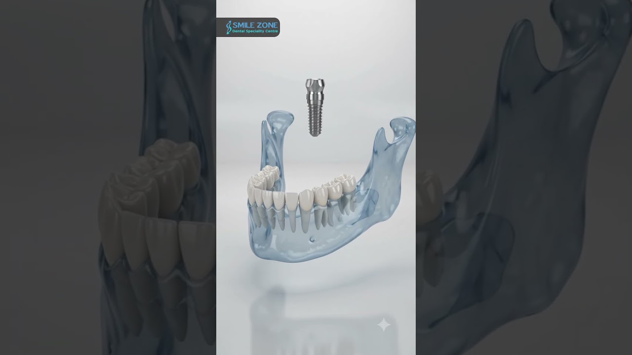 Missing a Tooth? 🦷 Discover Dental Implants | Dental Implant Clinic in Whitefield