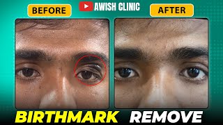 The Sad Truth Behind My Birthmark Removal | Awish Clinic | #youtubevideo #birthmarkremoval