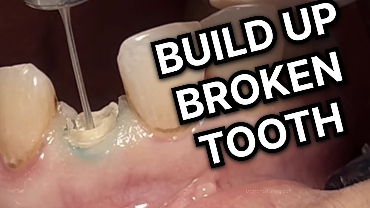 Build Up Broken Tooth in one hour - YouTube