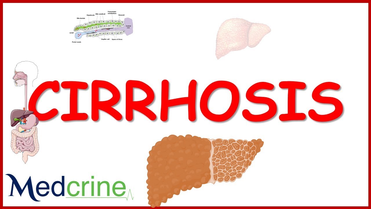 LIVER CIRRHOSIS (causes,pathophysiology,features,diagnosis,treatment