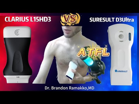 ATFL · D3Ultra vs Clarius L15 HD3 · Lineaire probe scanvoorbeeld