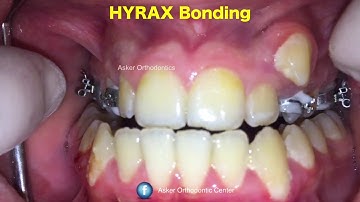 hyrax bonding application by Dr amr asker