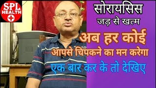 सोरायसिस का शर्तिया इलाज मात्र  2 दिनो मे ! SPL HEALTH ! Dr. RK Shrivastav !