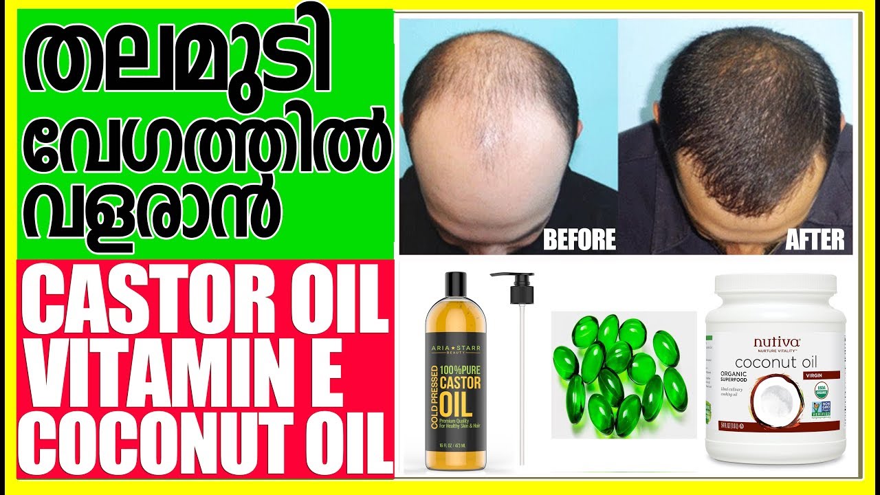 കഷണ്ടി മാറി തലമുടി വേഗത്തില്‍ വളരാന്‍ CASTOR OIL+VITAMIN E+COCONUT OIL