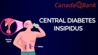 Central Diabetes Insipidus