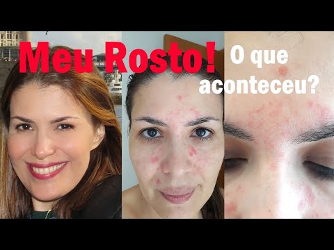 Vídeo: Como tratar dermatite seborréica em seu rosto (com fotos)