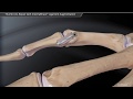 Thumb UCL Repair with InternalBrace™ Ligament Augmentation