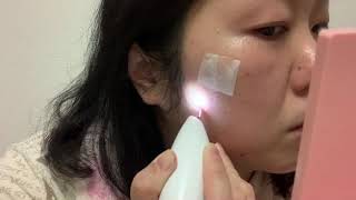 ほくろ除去ペン使ってみた#アラフォー