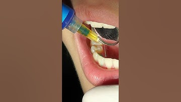 Tháo Mắc Cài: Đạt Được Nụ Cười Tự Tin Sau Thời Gian Niềng Răng | Bác sĩ Cường