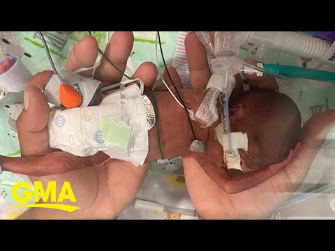 Baby born at 21 weeks named world’s most premature infant to survive l GMA