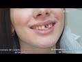 Stomatologie Chisinau, Botanica-TerraDent, Moldova!  Coroana din Ceramica cu  ZIRCONIU - PE IMPLANT.