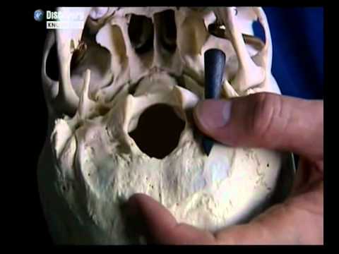 Henry V arrowhead removal | WillieWillieHarrySte | YouTube | Published on September 13, 2010