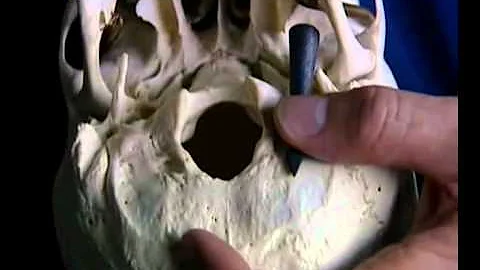 Henry V arrowhead removal