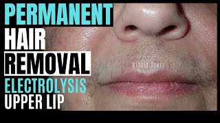 Electrolysis hair removal, regrowth, time between session and total duration.