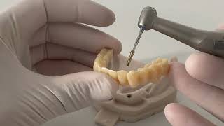 How to Insert All-on-X Provisionals with matrix® Implants | Tutorial