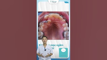 Kéo Răng Mọc Ngầm Khi Niềng Răng Mất Bao Lâu | Nha Khoa Minh Châu
