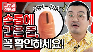 Please...Take a look at your nails🔥 (how to distinguish between melanonychia and melanoma)