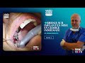 Partie 2  bridge sur implant en mise en charge immdiate  dr bruno barjou