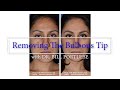 Rhinoplasty Surgery - Reduction/Removing a Bulbous Nasal Tip  - #rhinoplasty