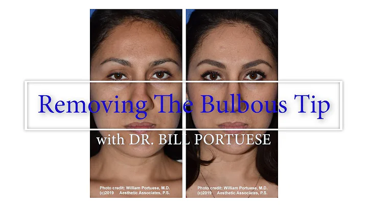 Achieve a Refined Nose with Bulbous Nasal Tip Reduction Surgery