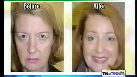 Satisfied Eyelid Lift Patient Janet McMahan