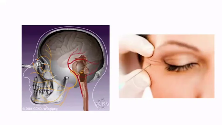 Hemifacial Spasm with Dr. Dong Kim - DayDayNews