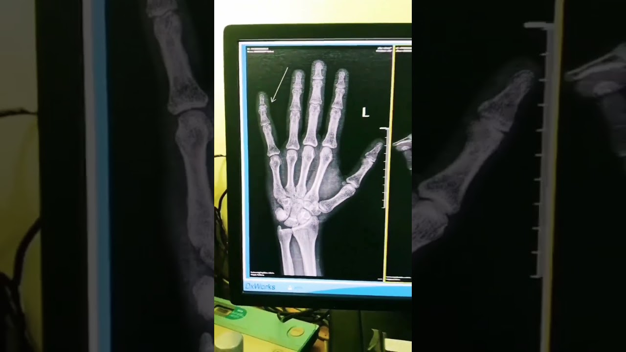 X-ray Left hand AP and lateral view Showing fracture in lateral view