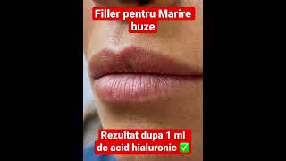 Filler Pentru Marire Buze. Rezultat Dupa 1 Ml De Acid Hialuronic Programari 0753876867