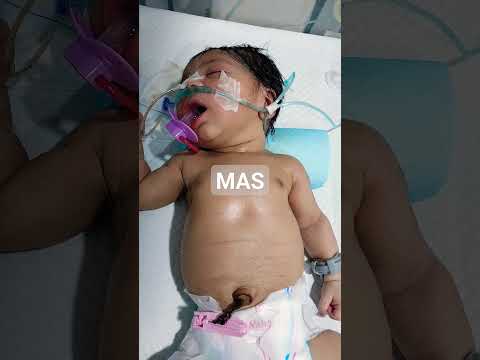 #baby #newborn #nicu