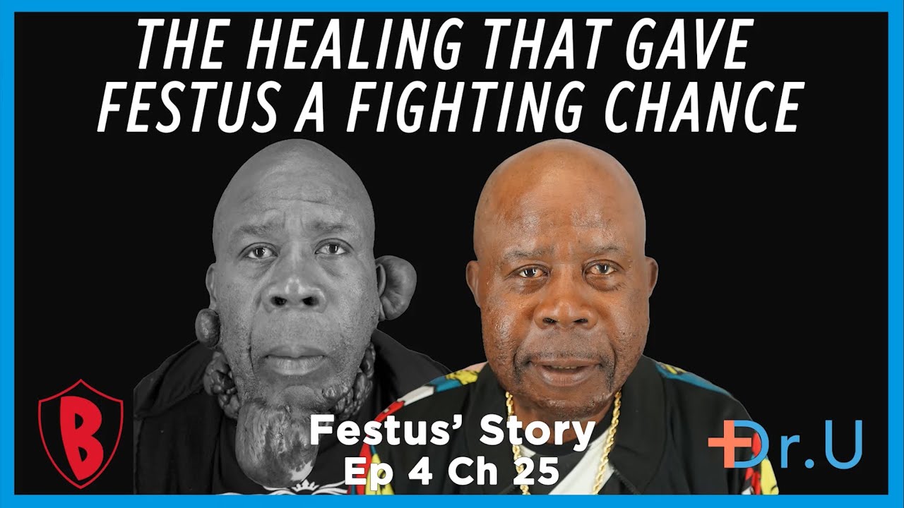Festus’s First Side Healed. What Happens to the Remaining Keloids?